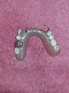 Luke's denture 2